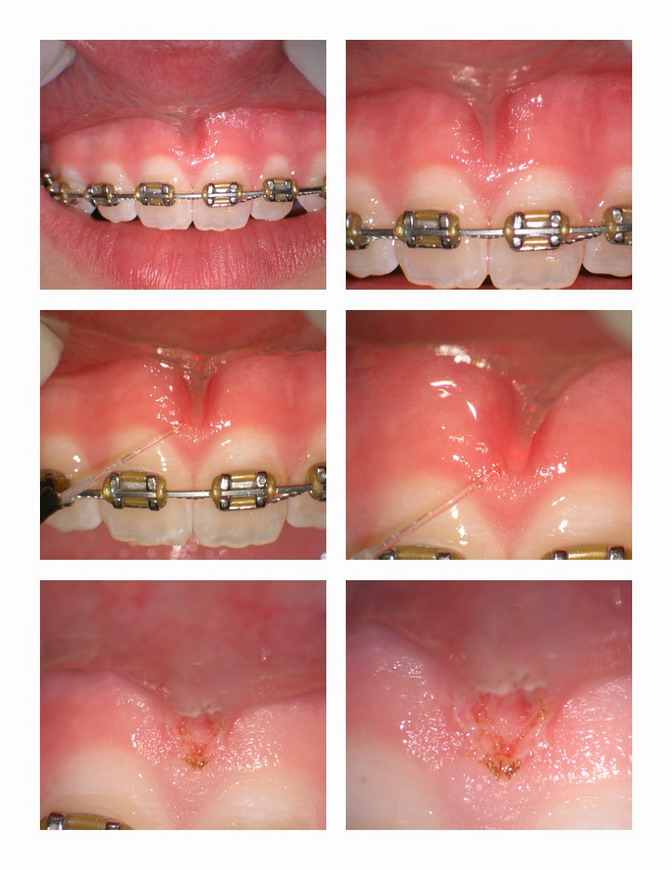 Frenectomy pg 1.jpg